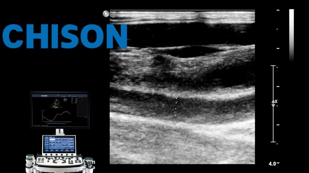 Ultrasonido de Vesícula